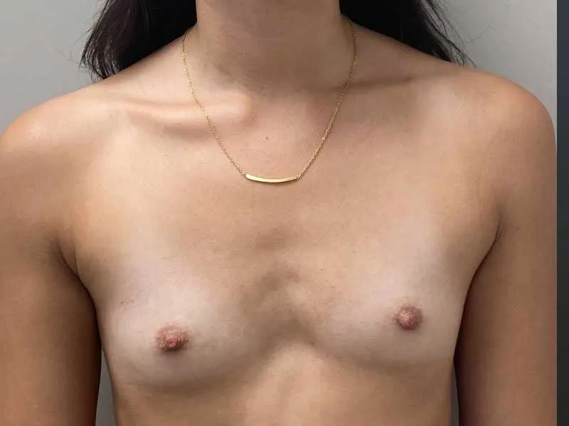 Breast augmentation before, view 1