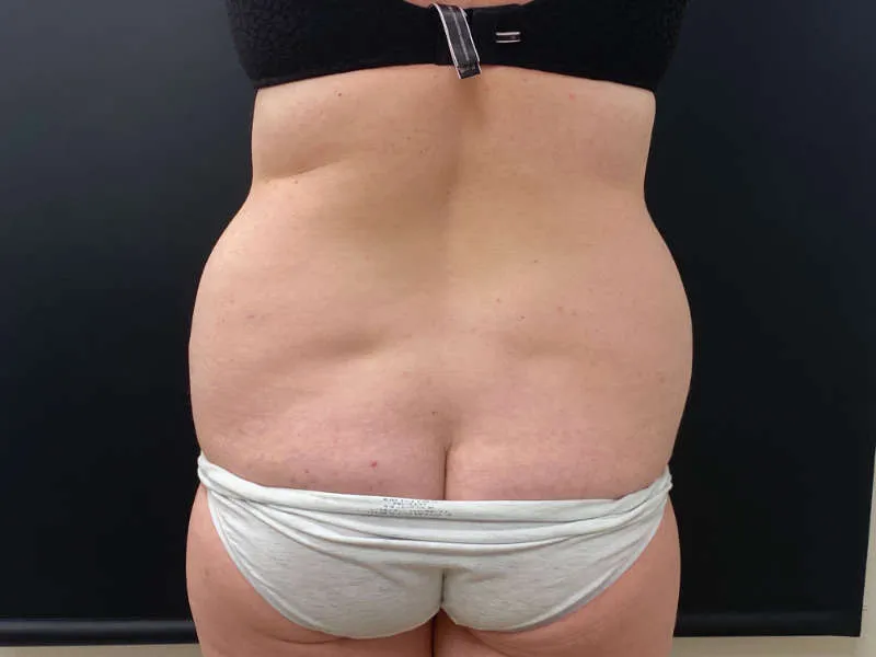 Tummy Tuck and Liposuction before — Tummy Tuck and Liposuction, view 3