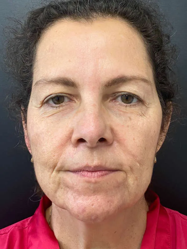 Laser Skin Resurfacing before — Laser Resurfacing, view 1
