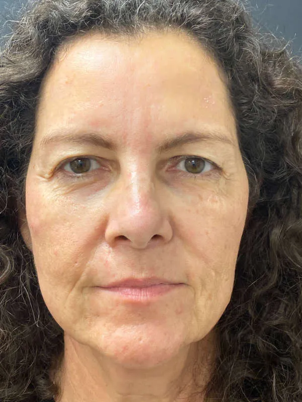 Laser Skin Resurfacing after — Laser Resurfacing, view 1