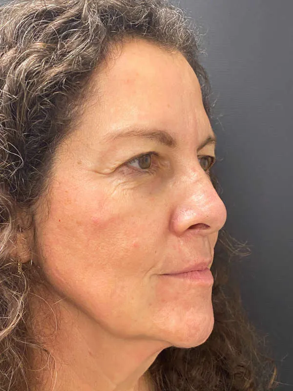 Laser Skin Resurfacing after — Laser Resurfacing, view 3