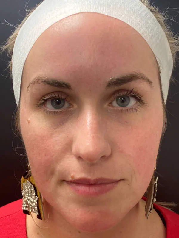 Laser Skin Resurfacing before — Laser Resurfacing, view 1