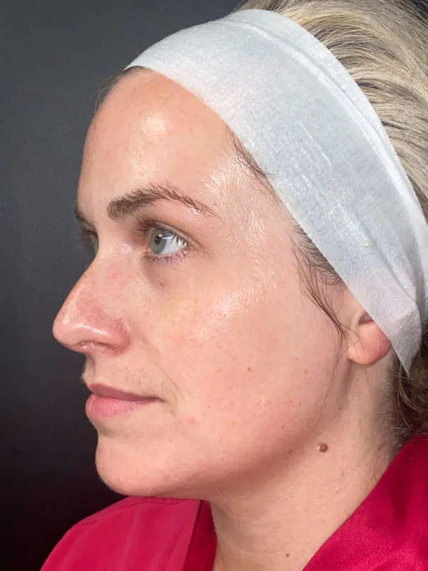 Laser Skin Resurfacing after — Laser Resurfacing, view 2