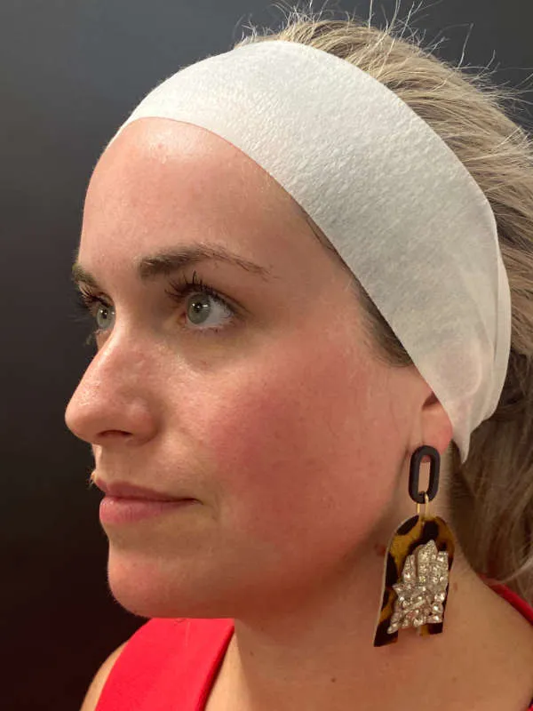 Laser Skin Resurfacing before — Laser Resurfacing, view 2