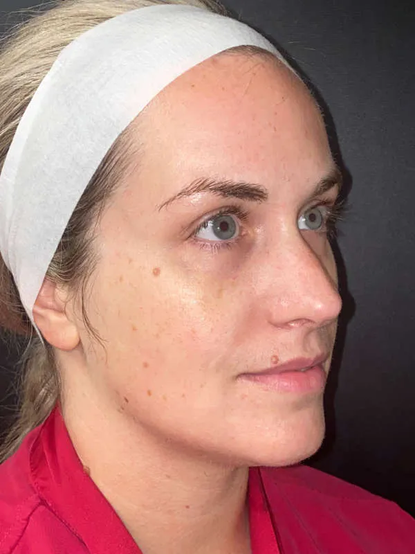 Laser Skin Resurfacing after — Laser Resurfacing, view 3