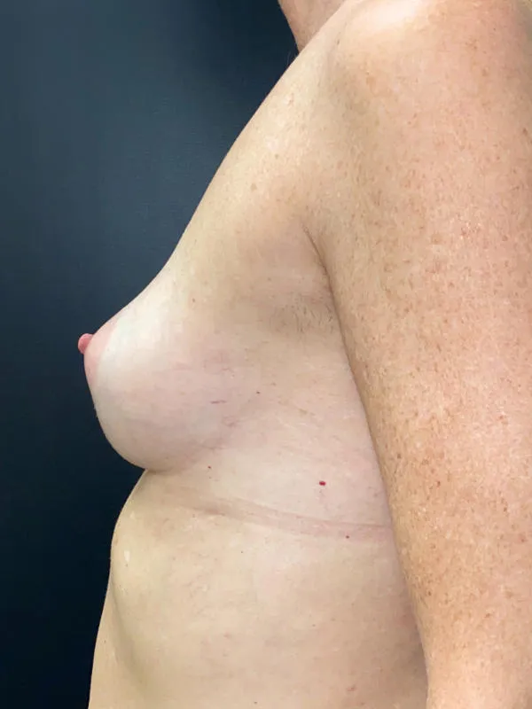 Breast Reconstruction after — Breast Reconstruction, view 3
