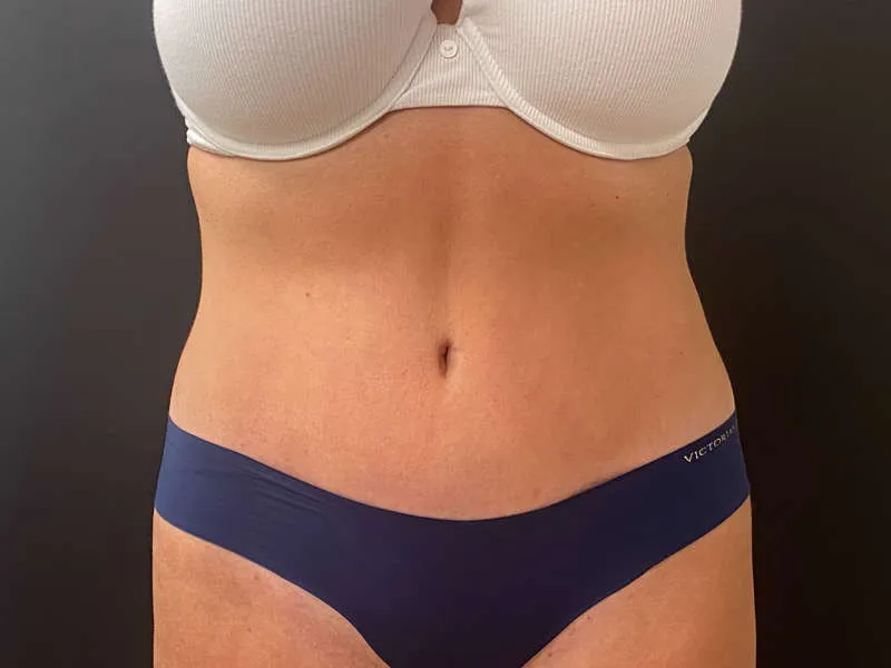 Tummy Tuck and Liposuction after — Tummy Tuck and Liposuction, view 1