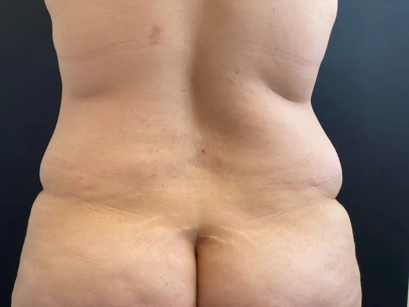Tummy Tuck and Liposuction before — Tummy Tuck and Liposuction, view 3