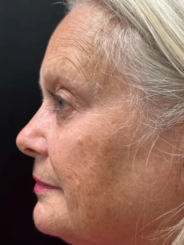 Laser Skin Resurfacing before — Laser Resurfacing, view 2