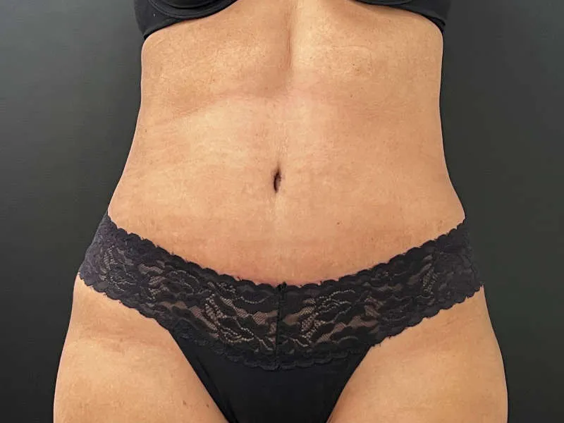 Tummy tuck and liposuction patient 3, after surgery