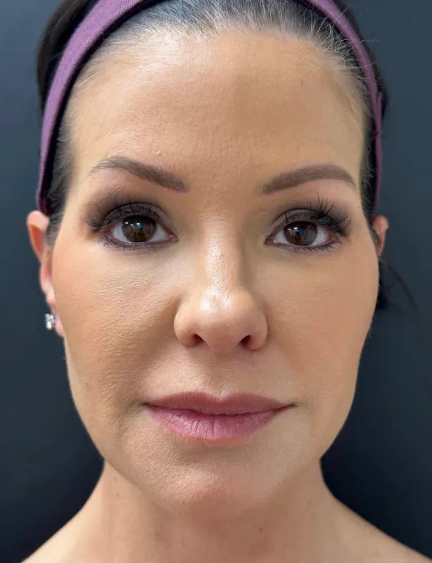 Facelift after — Lower Face and Neck Muscle Repair “Mini Facelift”, view 1