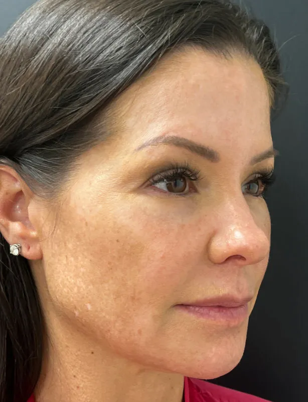Facelift before — Lower Face and Neck Muscle Repair “Mini Facelift”, view 2