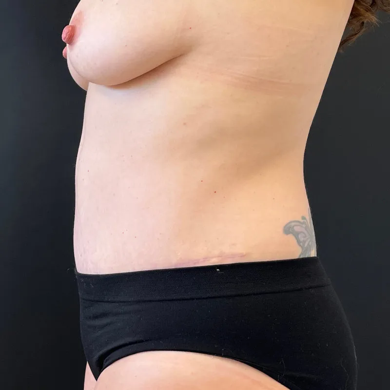 Tummy Tuck and Liposuction after — Tummy Tuck and Liposuction, view 3