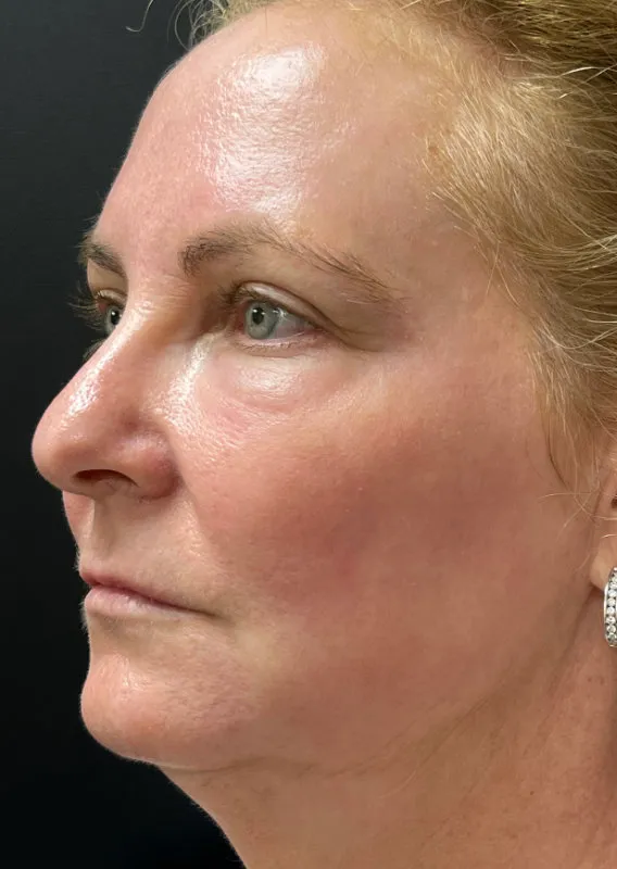 Phenol Peel after — Phenol Peel, view 2