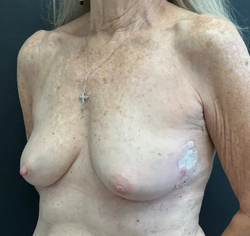 Breast Reconstruction before — Breast Reconstruction, view 2