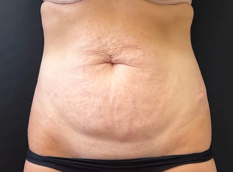 Tummy Tuck and Liposuction before — Tummy Tuck and Liposuction, view 1