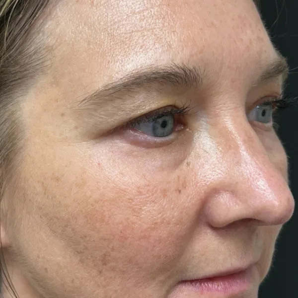 Laser Skin Resurfacing before — Laser Resurfacing, view 1