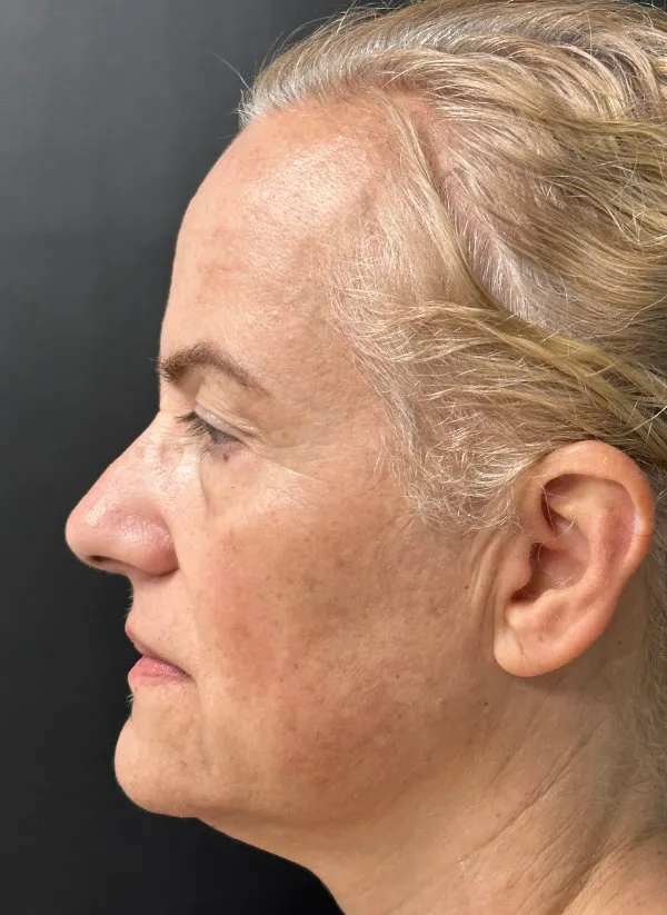 Laser Skin Resurfacing after — Laser Resurfacing, view 3