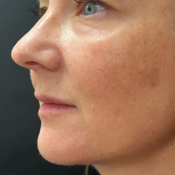 Laser Skin Resurfacing before — Laser Resurfacing, view 2