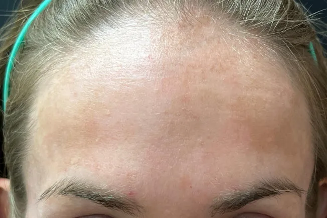 Laser Skin Resurfacing after — Laser Resurfacing, view 3