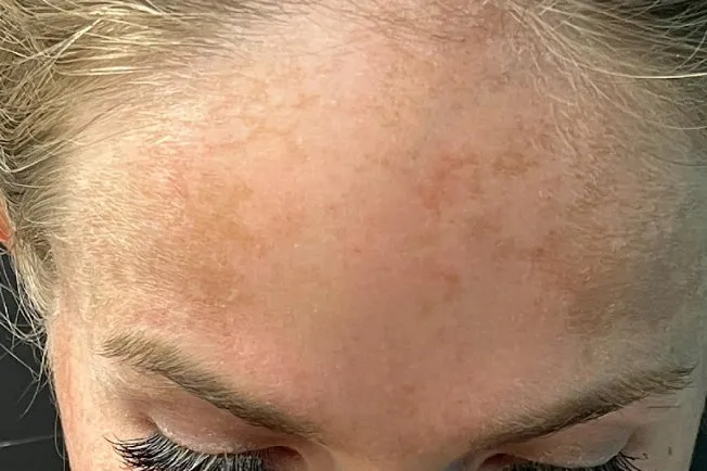 Laser Skin Resurfacing before — Laser Resurfacing, view 3