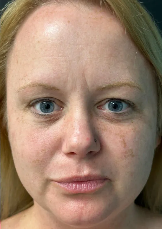Laser Skin Resurfacing after — Laser Resurfacing, view 1