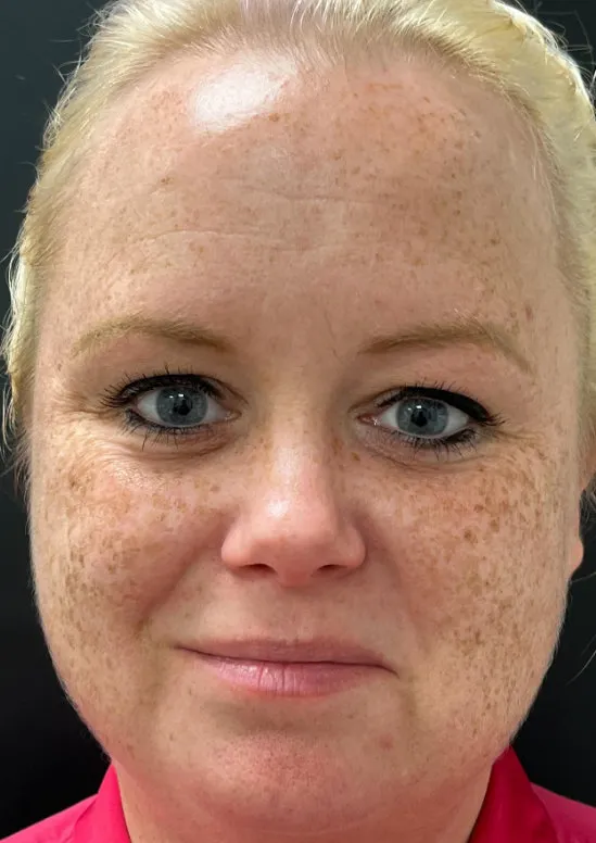 Laser Skin Resurfacing before — Laser Resurfacing, view 1