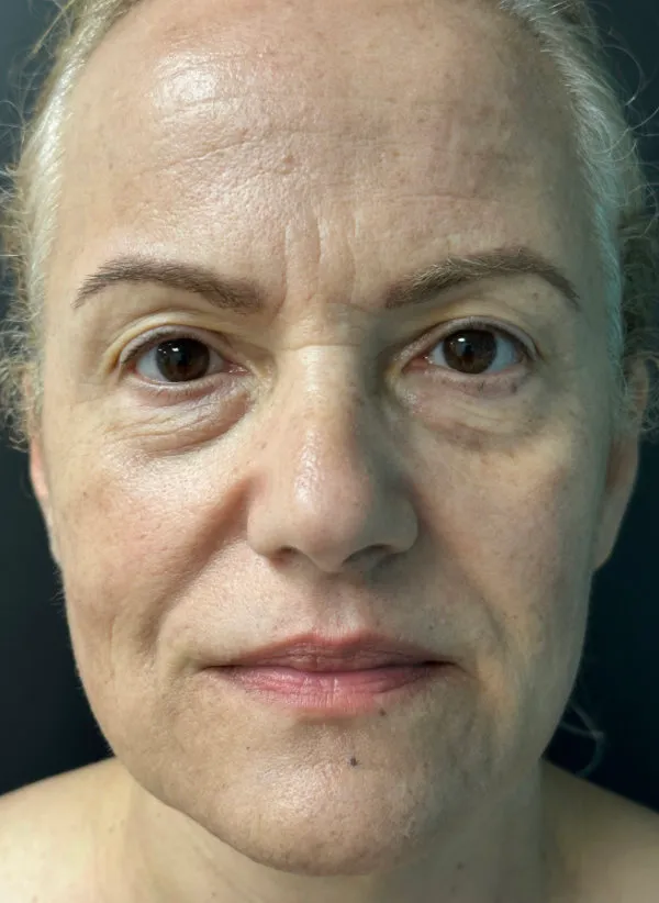 Laser Skin Resurfacing after — Laser Resurfacing, view 1