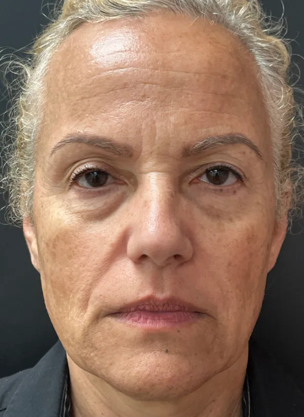 Laser Skin Resurfacing before — Laser Resurfacing, view 1