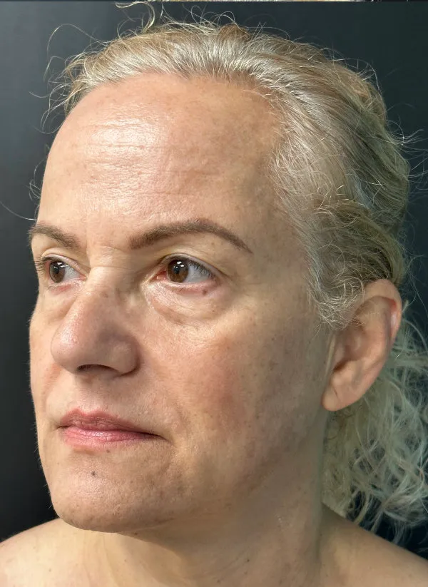 Laser Skin Resurfacing after — Laser Resurfacing, view 2