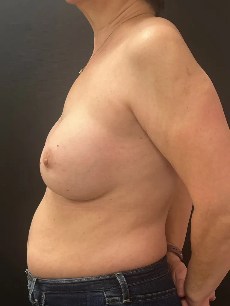 Breast Reconstruction after — Breast Reconstruction, view 3