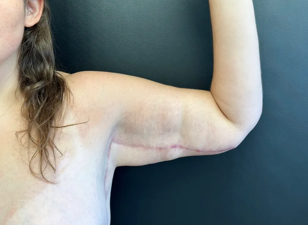 Arm Lift after — Arm Lift, view 1