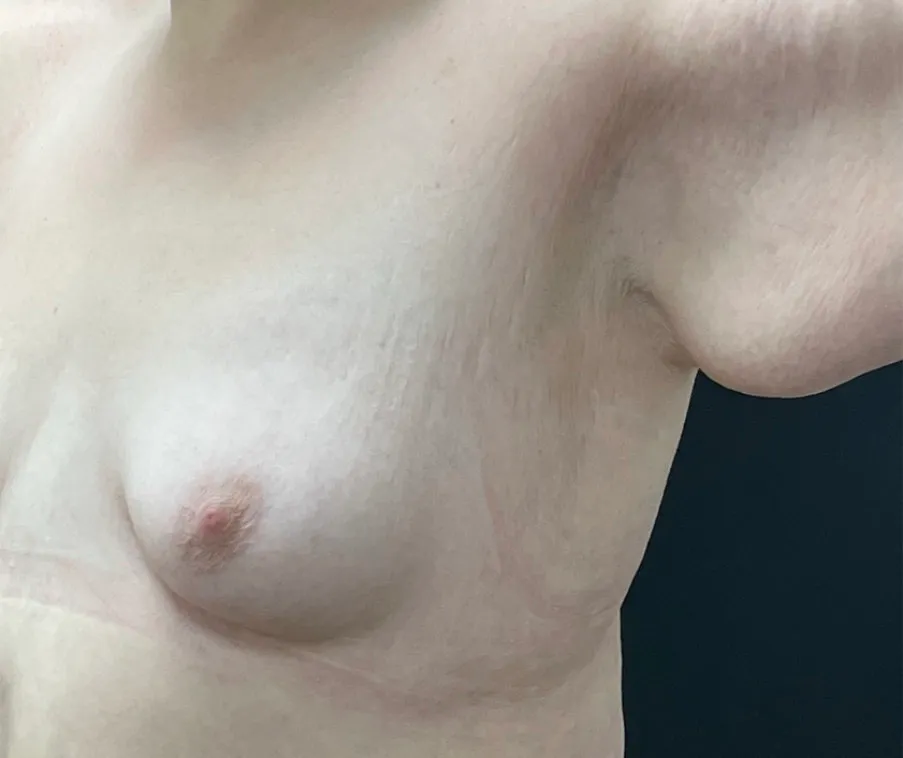 Arm Lift before — Arm Lift, view 1