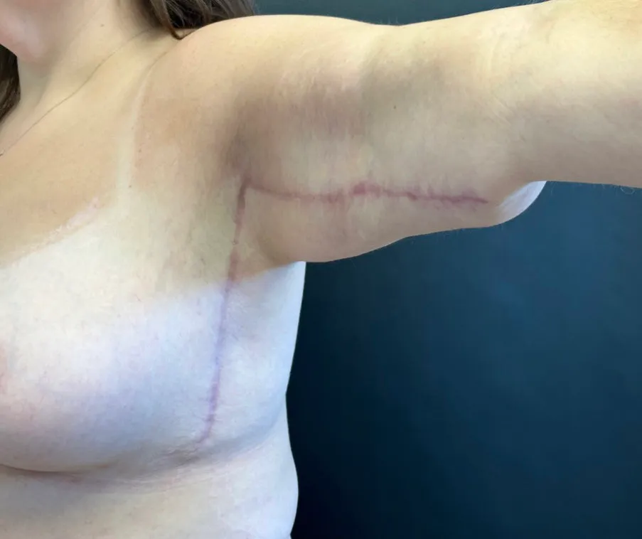 Arm Lift after — Arm Lift, view 1