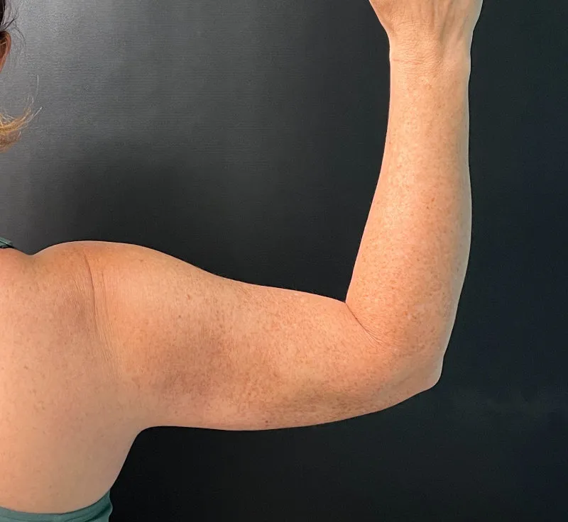 Arm Lift after — Arm Lift, view 2