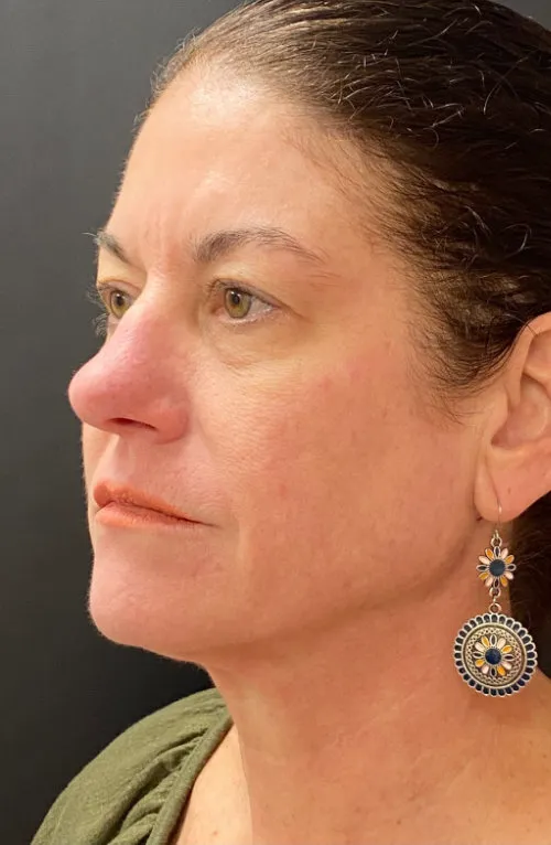 Laser Skin Resurfacing after — Laser Resurfacing, view 2