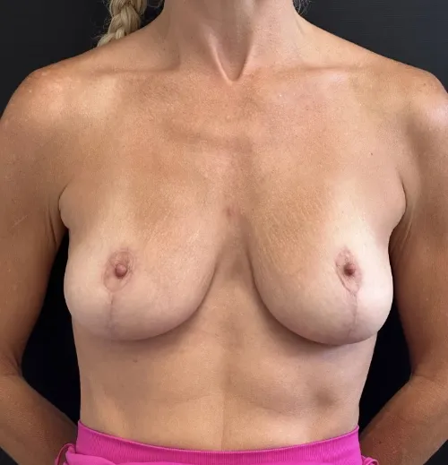 Breast Lift after — Breast Lift, view 1