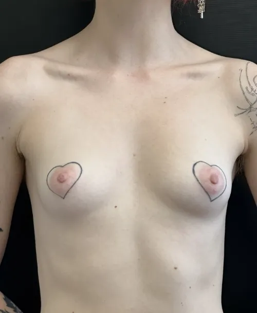 Breast augmentation before, view 1