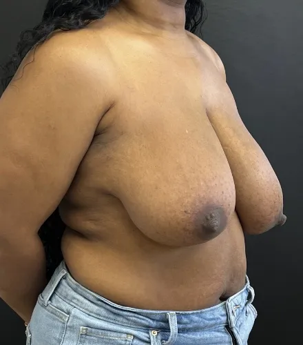Breast Reduction before — Breast Reduction, view 3