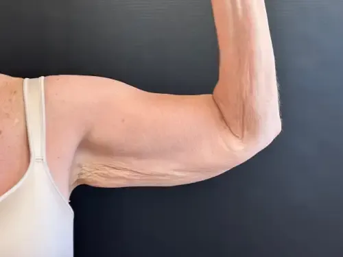 Surgery After Weight Loss before — Surgery After Weight Loss, view 1