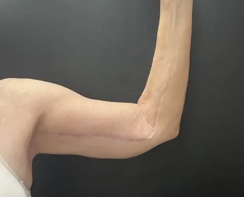 Surgery After Weight Loss after — Surgery After Weight Loss, view 1