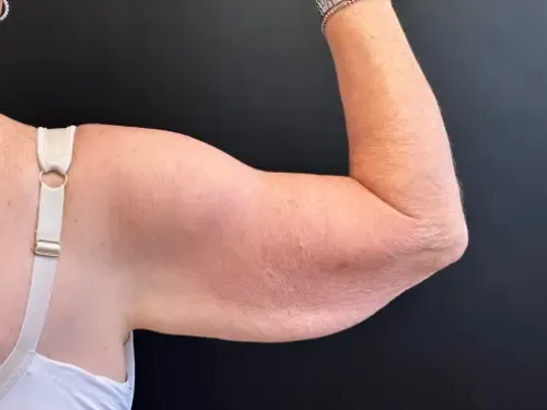 Surgery After Weight Loss before — Surgery After Weight Loss, view 2