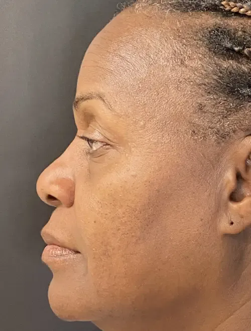 Laser Skin Resurfacing after — Laser Resurfacing, view 3