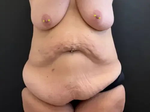 Surgery After Weight Loss before — Surgery After Weight Loss, view 1