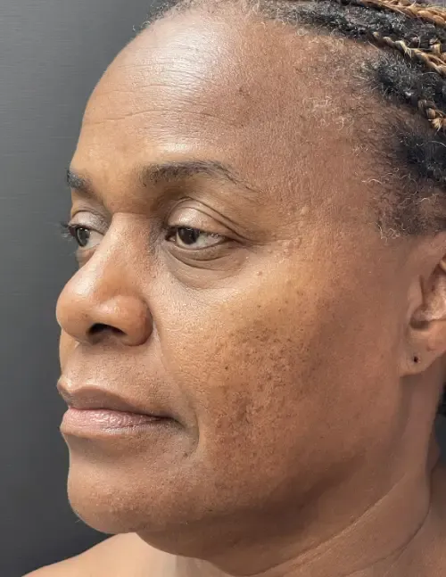 Laser Skin Resurfacing before — Laser Resurfacing, view 2