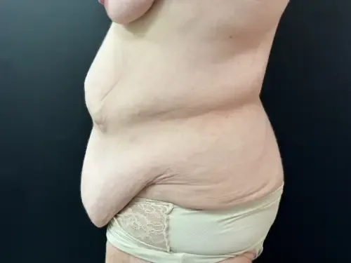 Tummy Tuck and Liposuction before — Tummy Tuck and Liposuction, view 3