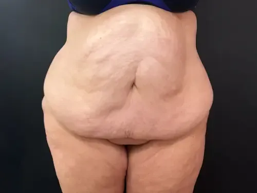 Surgery After Weight Loss before — Surgery After Weight Loss, view 1
