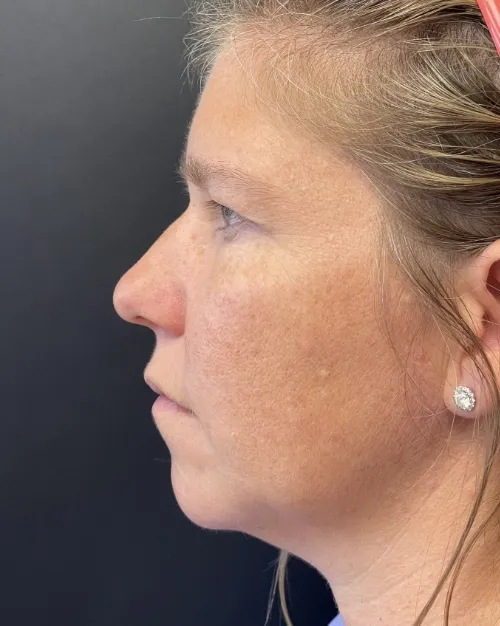 Laser Skin Resurfacing before — Laser Resurfacing