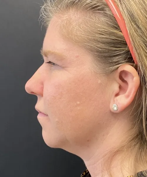 Laser Skin Resurfacing after — Laser Resurfacing
