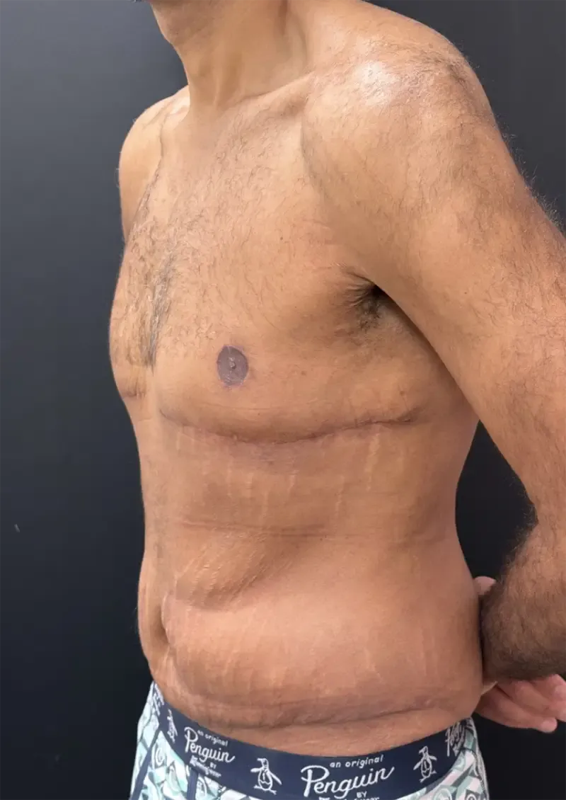 Surgery After Weight Loss after — Surgery After Weight Loss, view 2